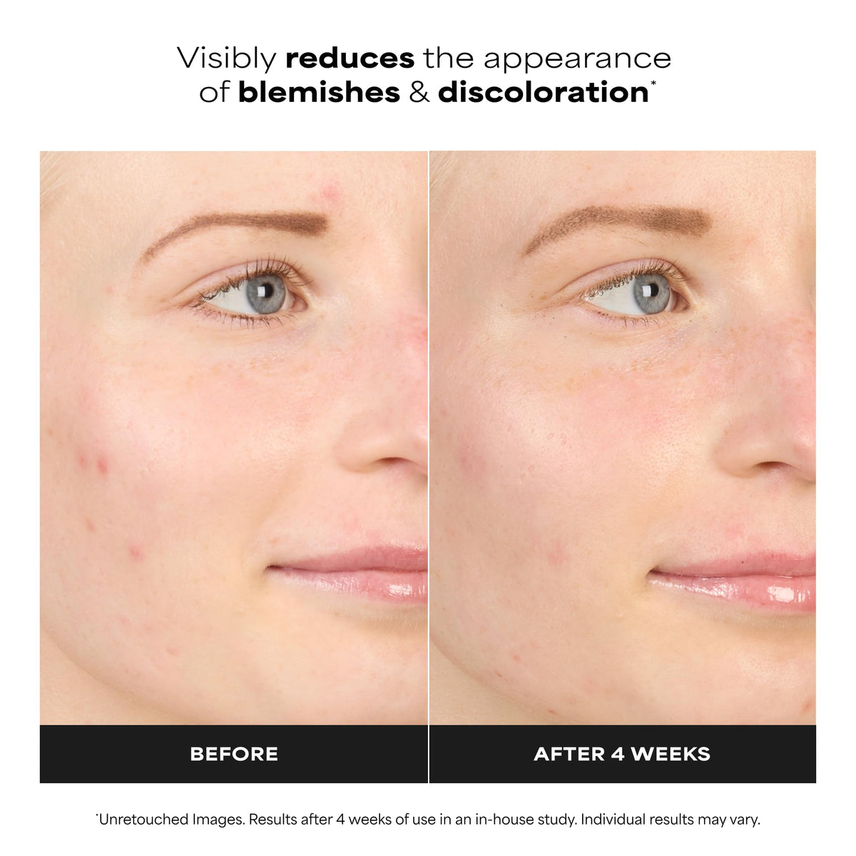 Paula’s Choice BOOST 10% Azelaic Acid Booster Cream Gel, Oil-Free Serum Fades Discoloration & Post-Blemish Marks, with Licorice Extract & Salicylic Acid, Fragrance-Free, 0.17 Fl Oz