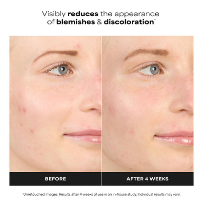 Paula’s Choice BOOST 10% Azelaic Acid Booster Cream Gel, Oil-Free Serum Fades Discoloration & Post-Blemish Marks, with Licorice Extract & Salicylic Acid, Fragrance-Free, 0.17 Fl Oz