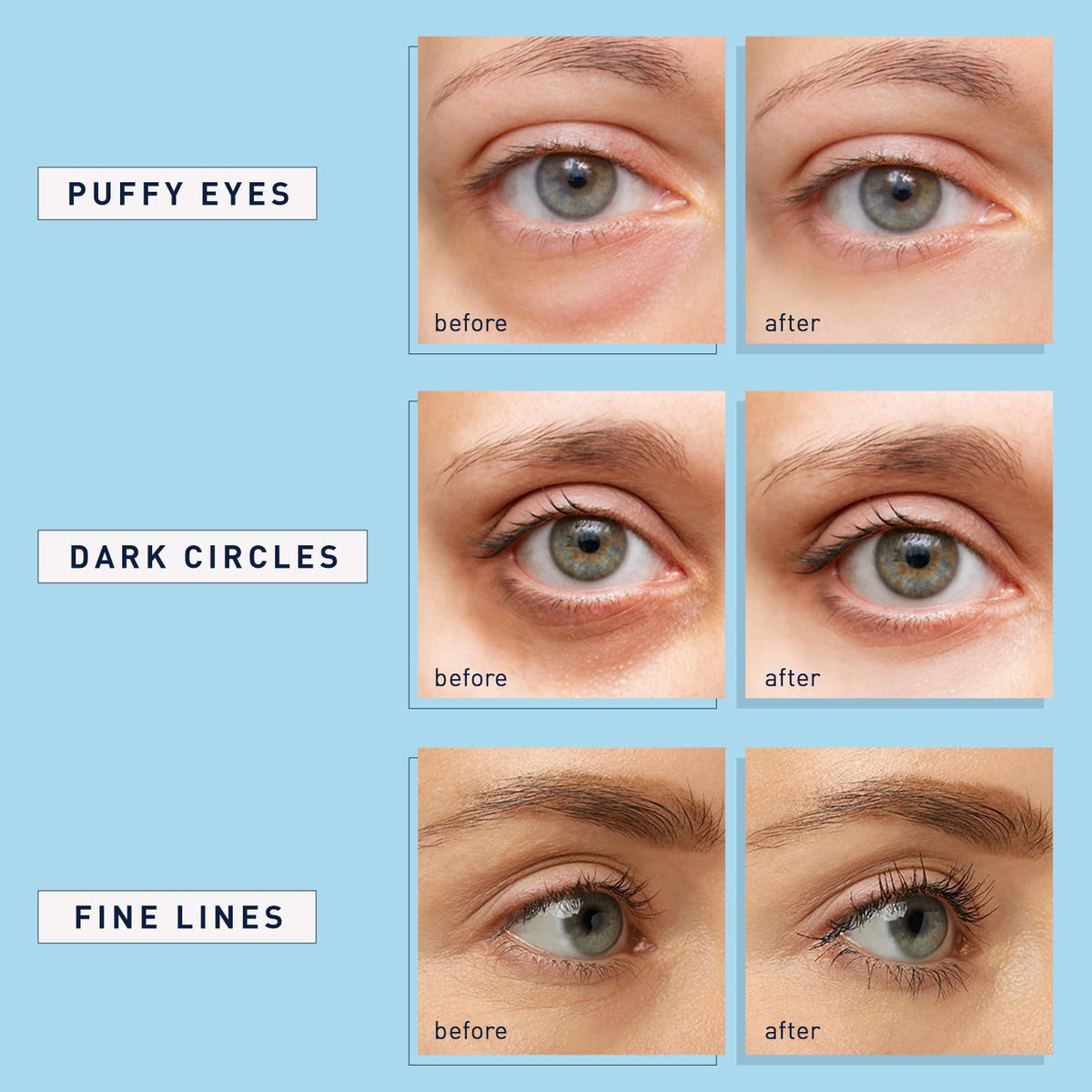 Enaskin Naturals Under Eye Patches (30 Pairs) - Retinol & Collagen Eye Mask Gels for Dark Circles, Puffiness & Wrinkles - Blue Cooling Treatment