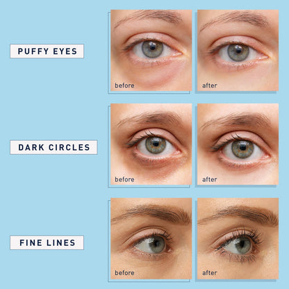 Enaskin Naturals Under Eye Patches (30 Pairs) - Retinol & Collagen Eye Mask Gels for Dark Circles, Puffiness & Wrinkles - Blue Cooling Treatment