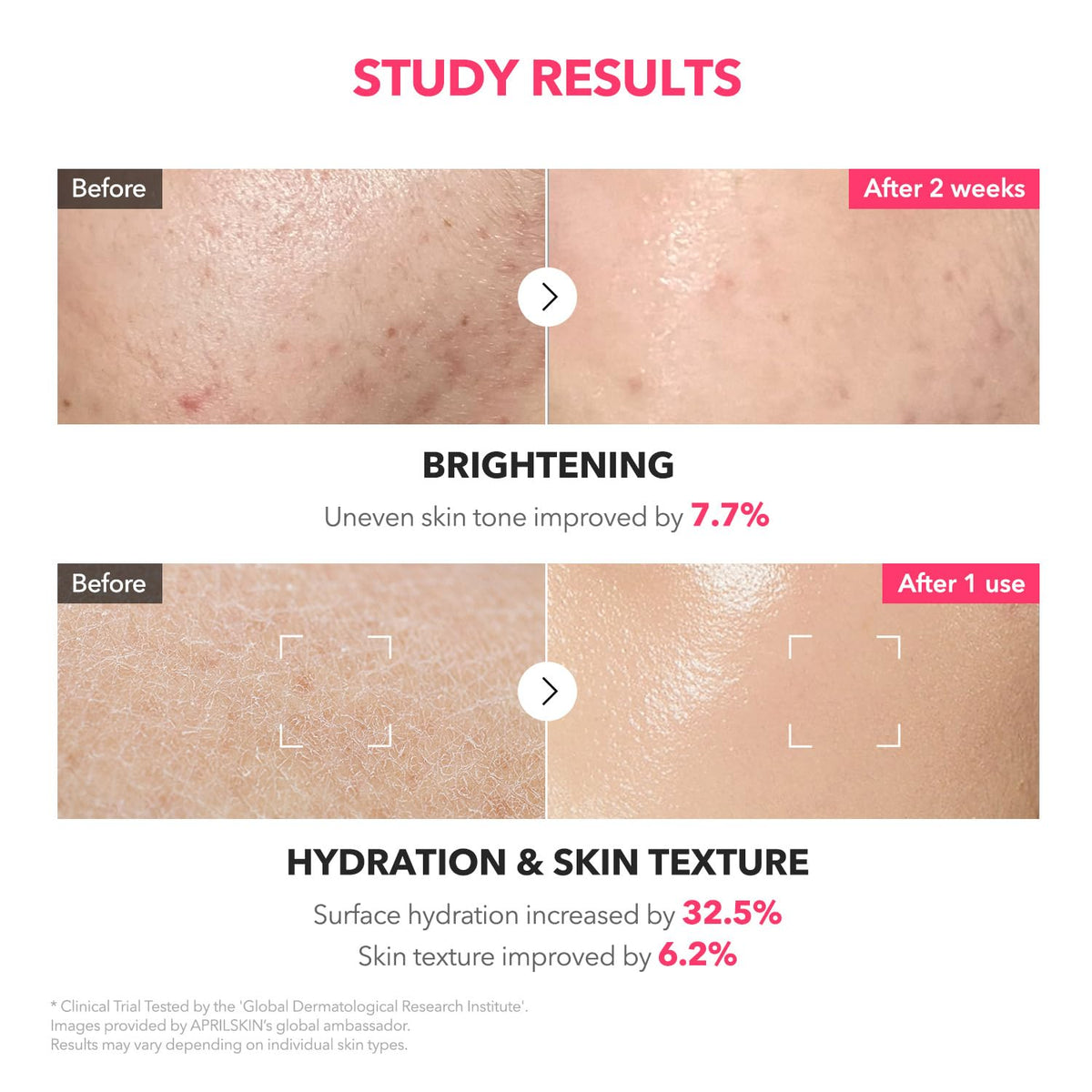 APRILSKIN TXA+Niacinamide 99 Pink Milky Toner - 99% High-Purity TXA 3%+ Niacinamide 5% for Brightening - Highly Concentrated Cream Toner - Deep Moisturizing Formula for Dull Skin - 5.07 fl.oz.