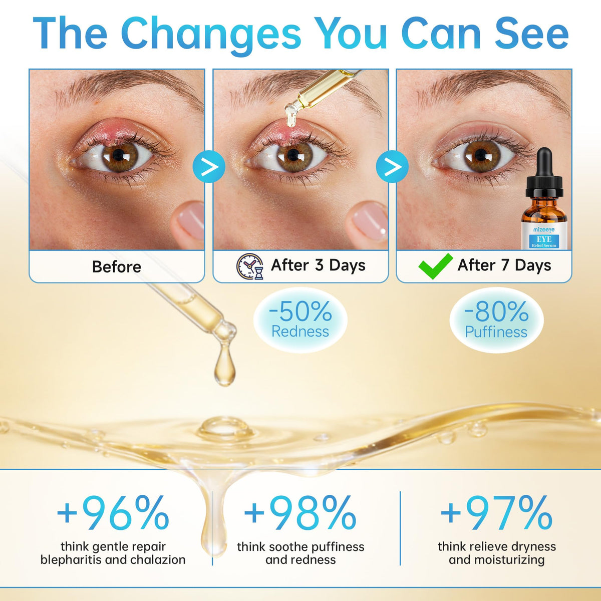 Eye Serum for Chalazion & Blepharitis - Eyelid Relief Set (2 PCS)