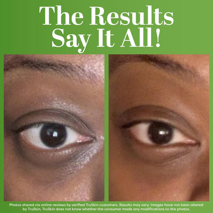 TruSkin Peptide Eye Cream Gel - Lightweight Treatment for Dark Circles & Fine Lines (15ml)