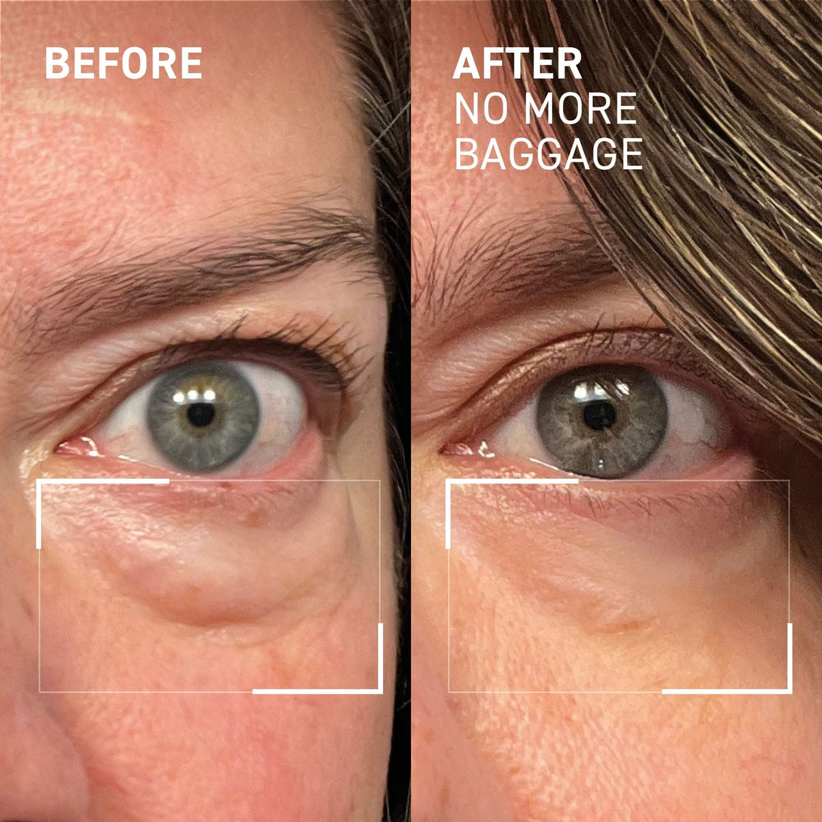 Dr. Brandt Needles No More, No More Baggage (Jumbo Size - 1 oz) - Instant Under-Eye De-Puffer & Dark Circle Eraser